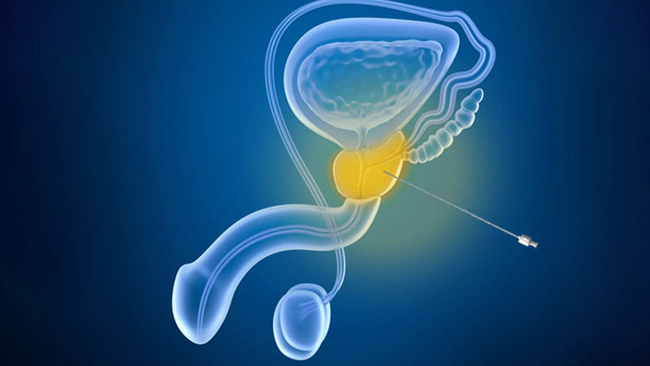 Biopsia De Pr Stata Qu Es C Mo Se Hace Y Para Qu Sirve Centro