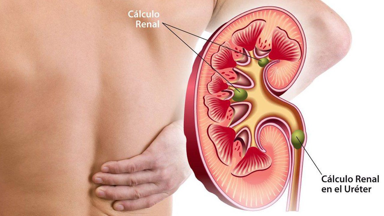 Cálculo Renal