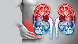 Cáncer de Riñón