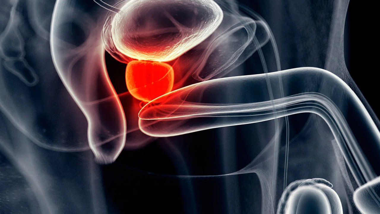 Cáncer de Próstata