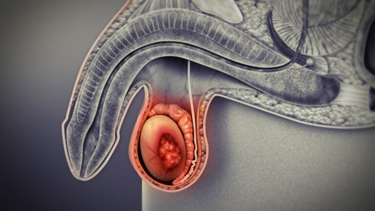 Cáncer de Testículo