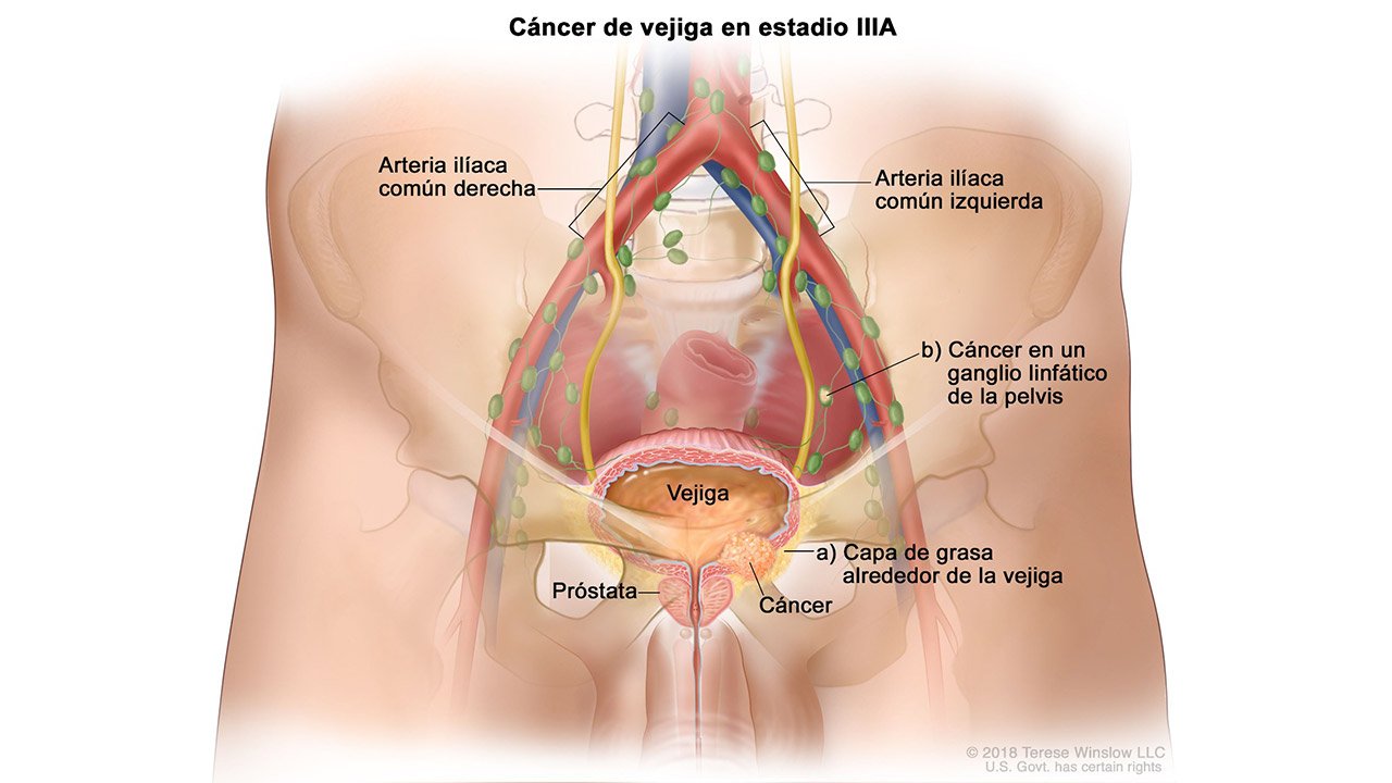 Cáncer de Vejiga