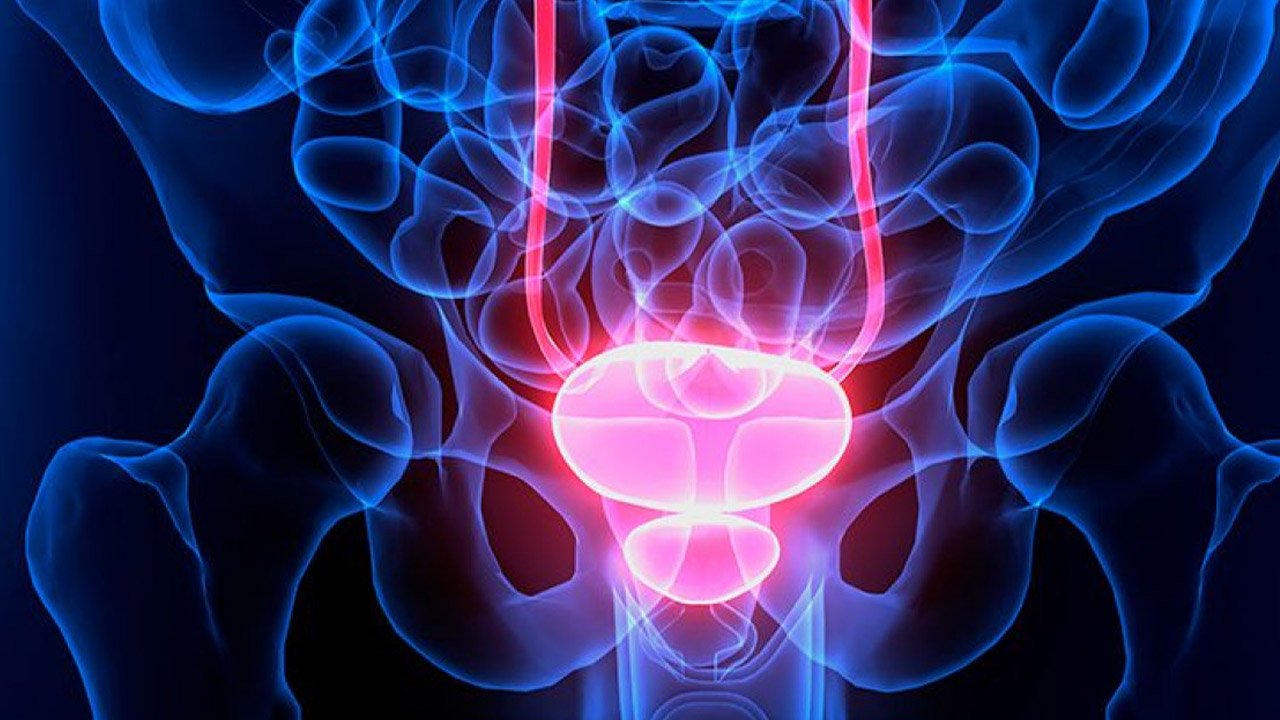 Otras enfermedades de la Vejiga