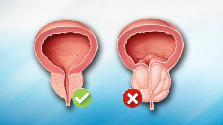 Hiperplasia Prostática