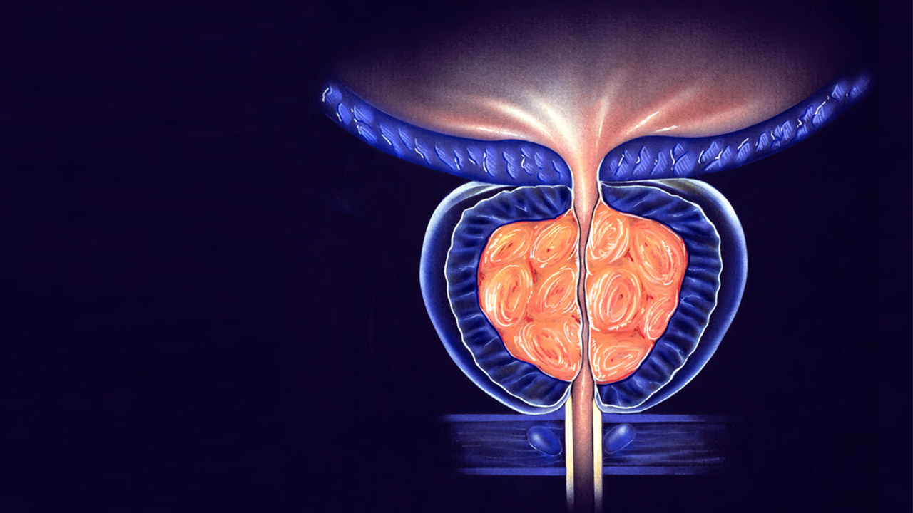 Prostatitis ¿qué Es Síntomas Y Tratamiento Centro Urologico De Alta Especialidad 9849