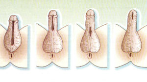Enfermedades del Pene