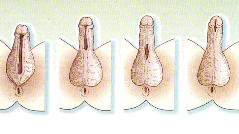 Enfermedades del Pene