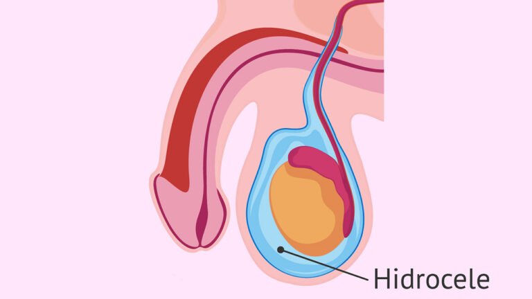 Otras enfermedades del Testículo